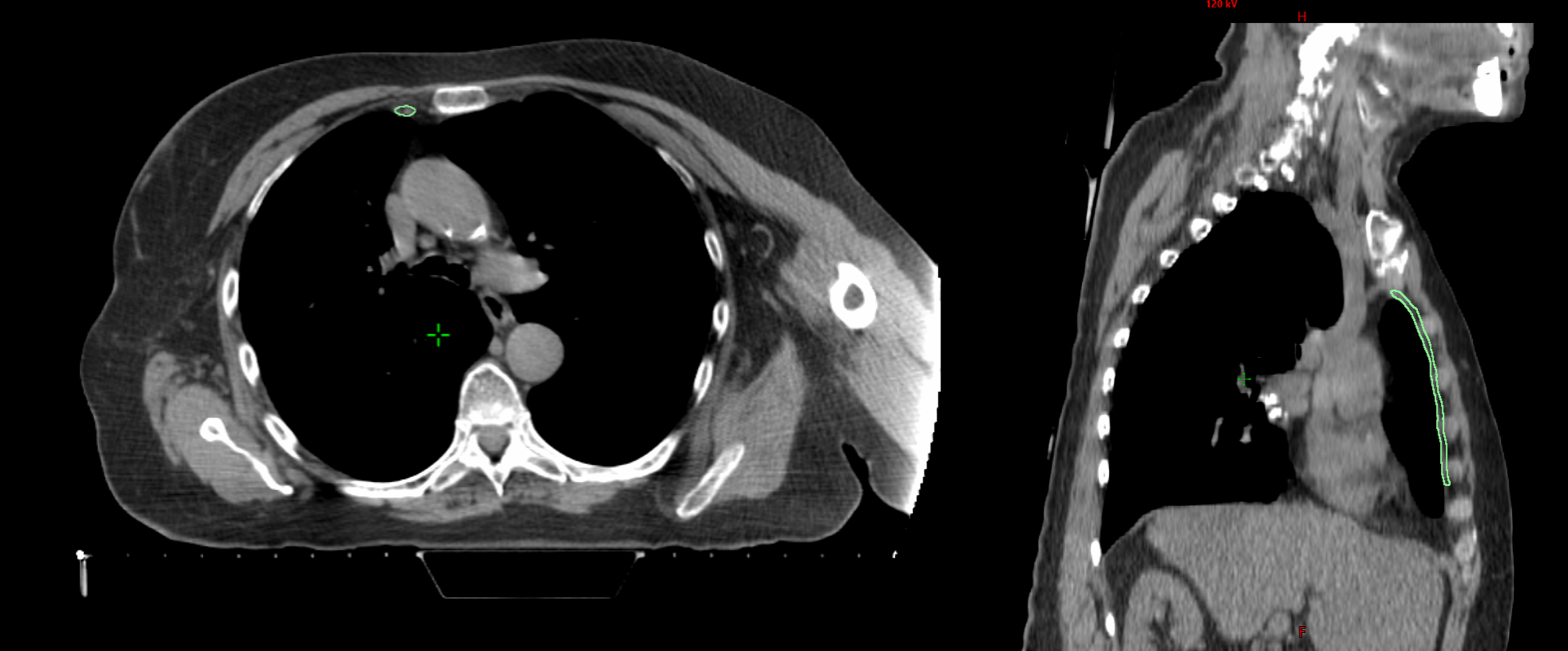 Bad IMN Contour Example